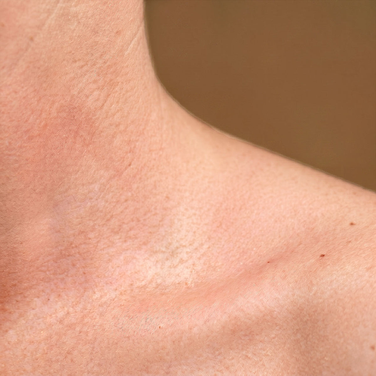 Gevoelige huid - Body
